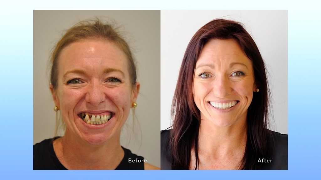 dental implants before after calgary ne
