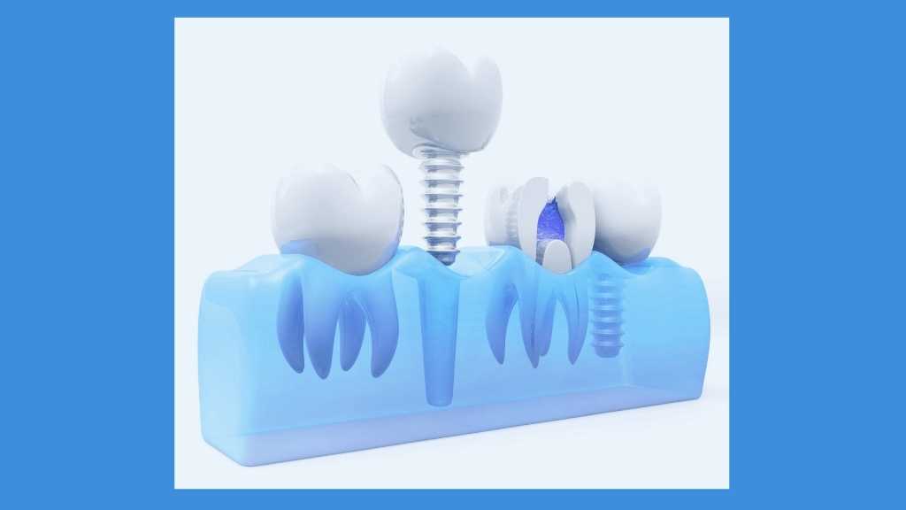 dental implants calgary ne