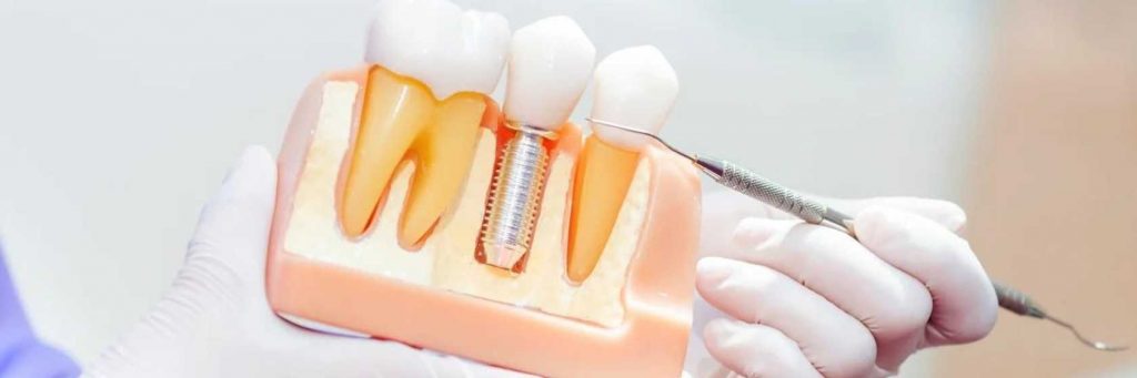 dentist dental implants calgary ne