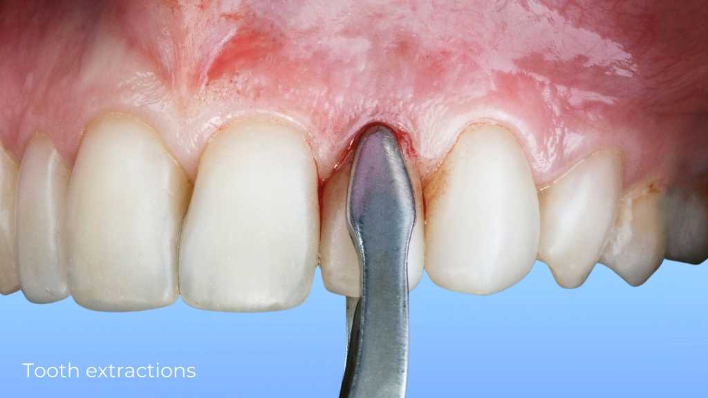 tooth extraction dentist calgary ne