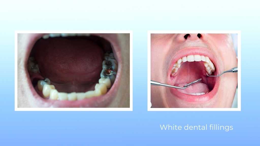 white dental fillings-calgary-ne