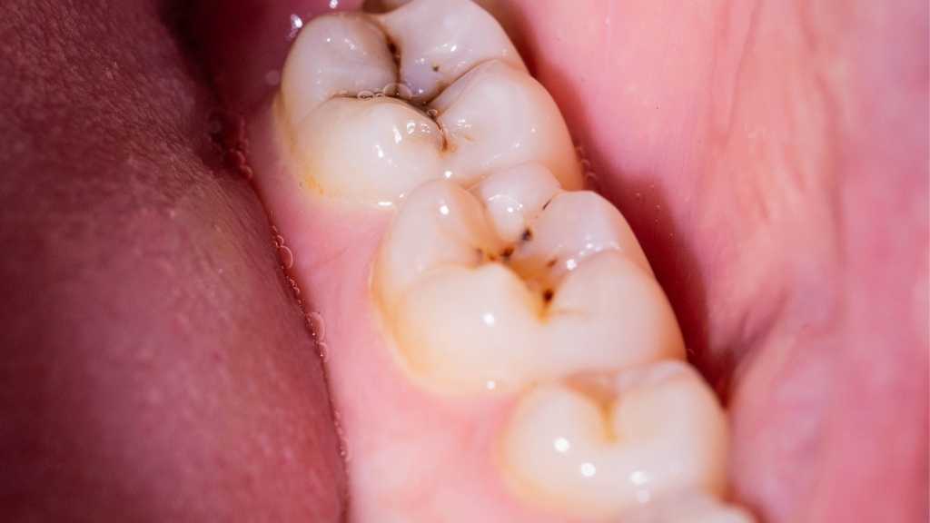 stained white fillings