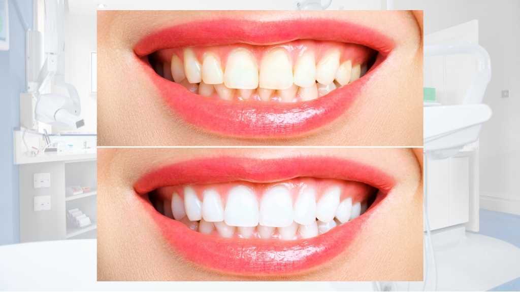 teeth whitening dentist calgary ne