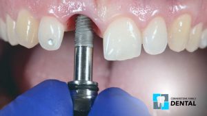 dental-implants-dentist-calgary-ne