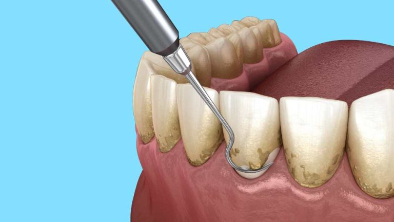 calgary-ne-dentist-gum-disease